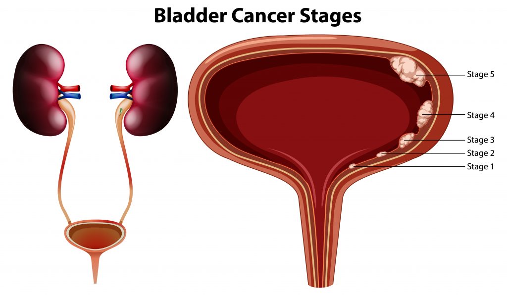 how curable is bladder cancer